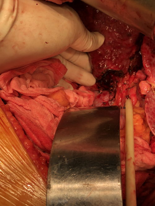 全球第二例猪心移植患者手术满月 未出现排异反应