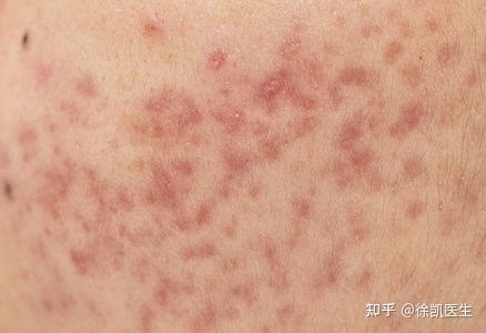 同位素_同位素治疗疤痕疙瘩