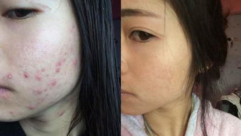 适合懒人长痘的绿植_容易长痘适合用什么水乳--第1张